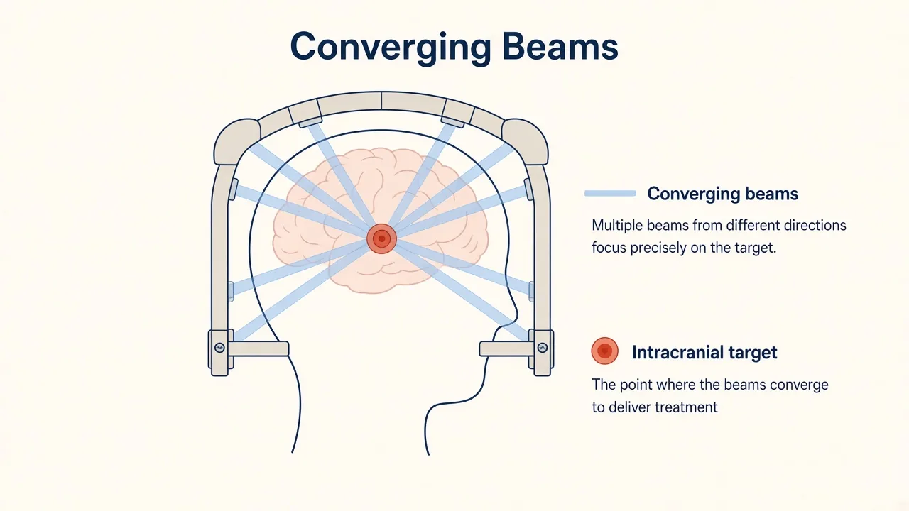 Illustration of converging intracranial radiosurgery beams focused on a small brain target