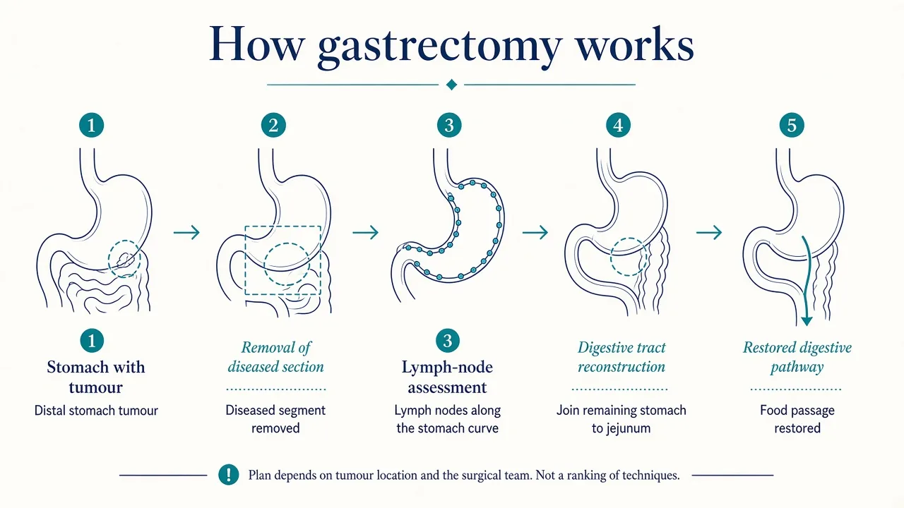 Medical illustration showing the main steps of gastrectomy from removal of diseased stomach tissue to digestive tract reconstruction