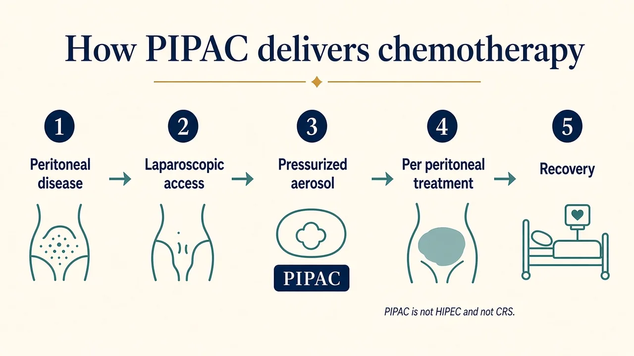 Medical illustration explaining how PIPAC delivers pressurized aerosol chemotherapy into the abdominal cavity