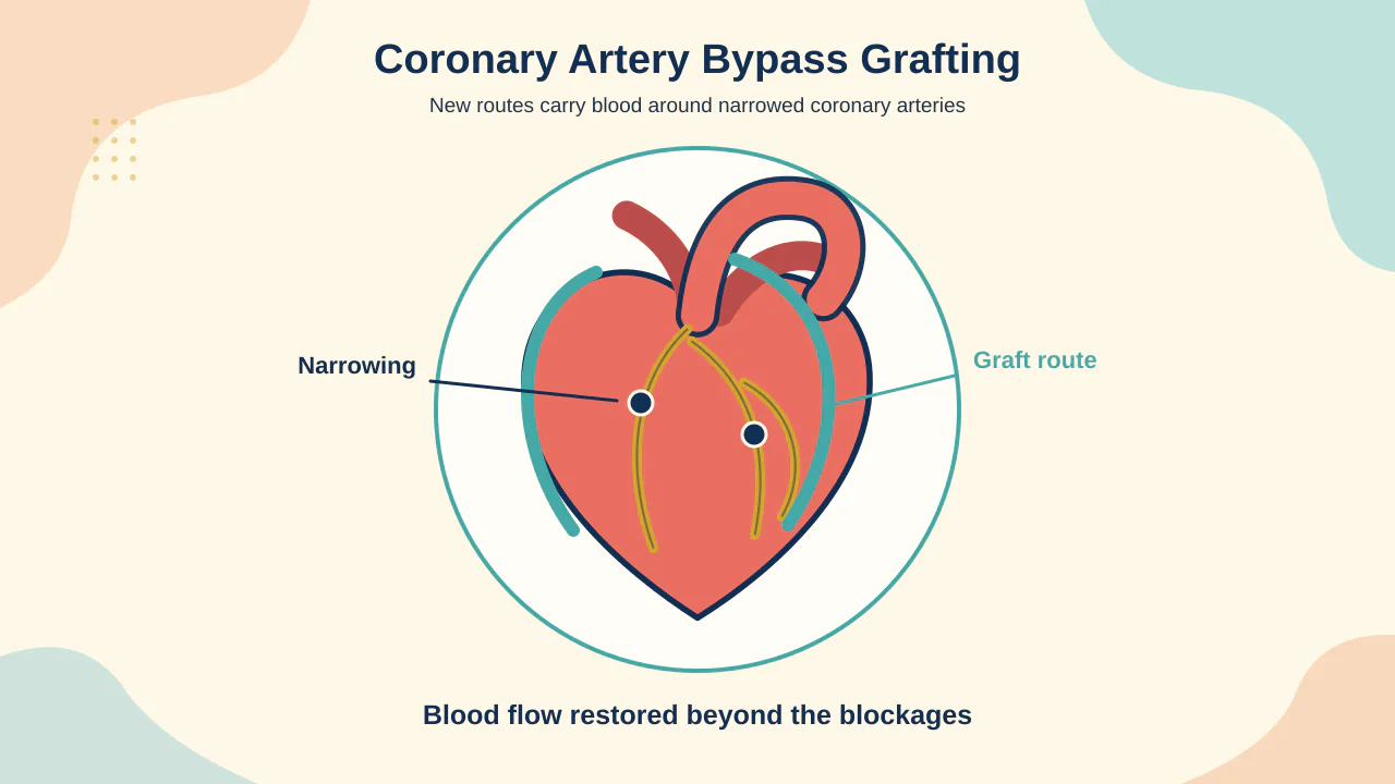 Medical illustration of internal thoracic artery, radial artery and vein bypass grafts carrying blood around blocked coronary arteries