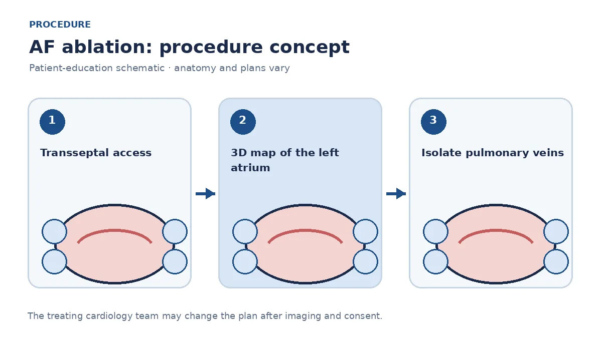 Clinical diagram of transseptal catheter mapping and pulmonary-vein isolation during AF ablation