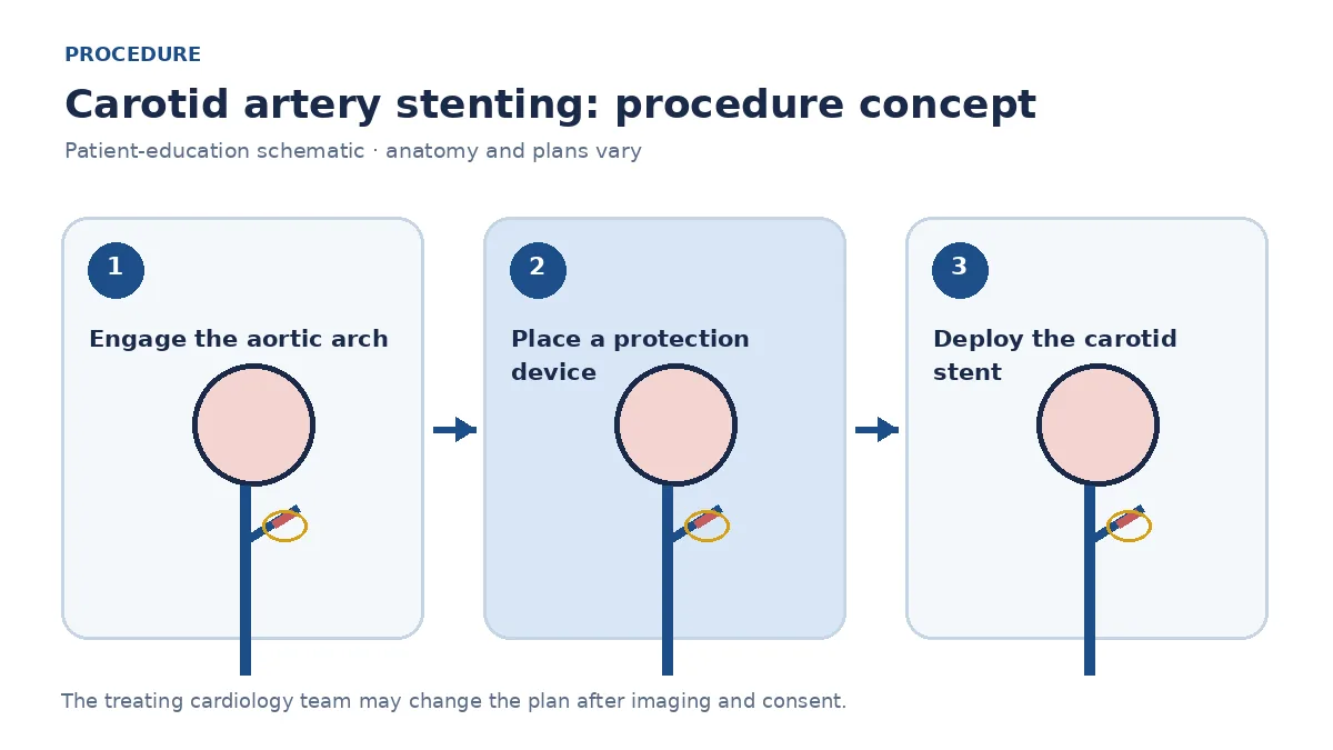 Clinical diagram of embolic-protection-device placement and carotid stent deployment