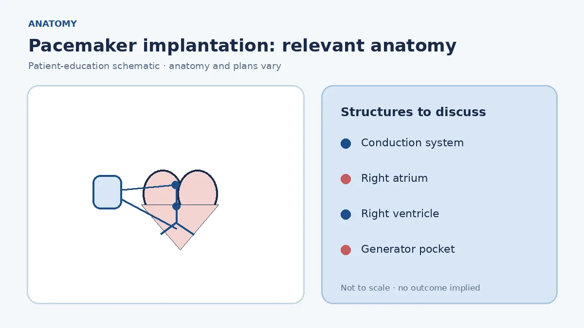 Medical illustration of the heart's conduction system and chambers relevant to bradycardia pacing