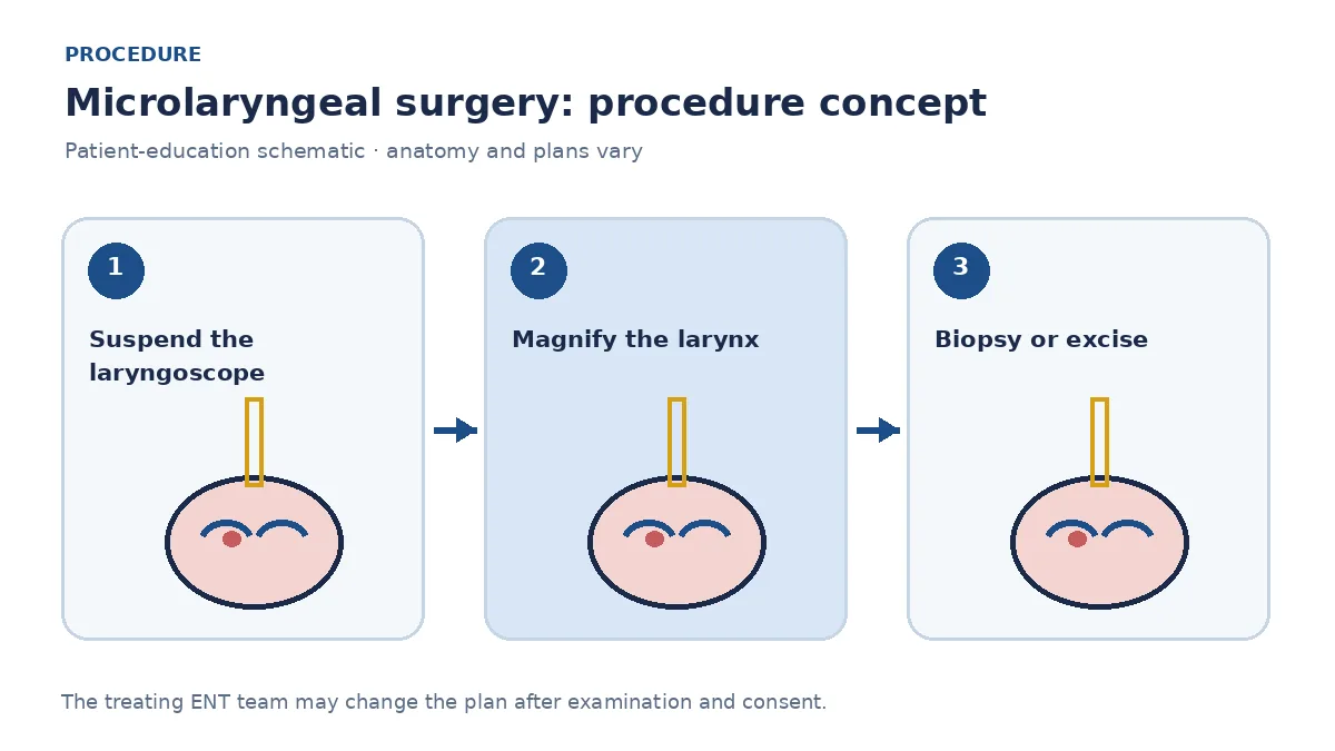 Clinical diagram of suspension laryngoscopy and microscope-guided instruments in the larynx