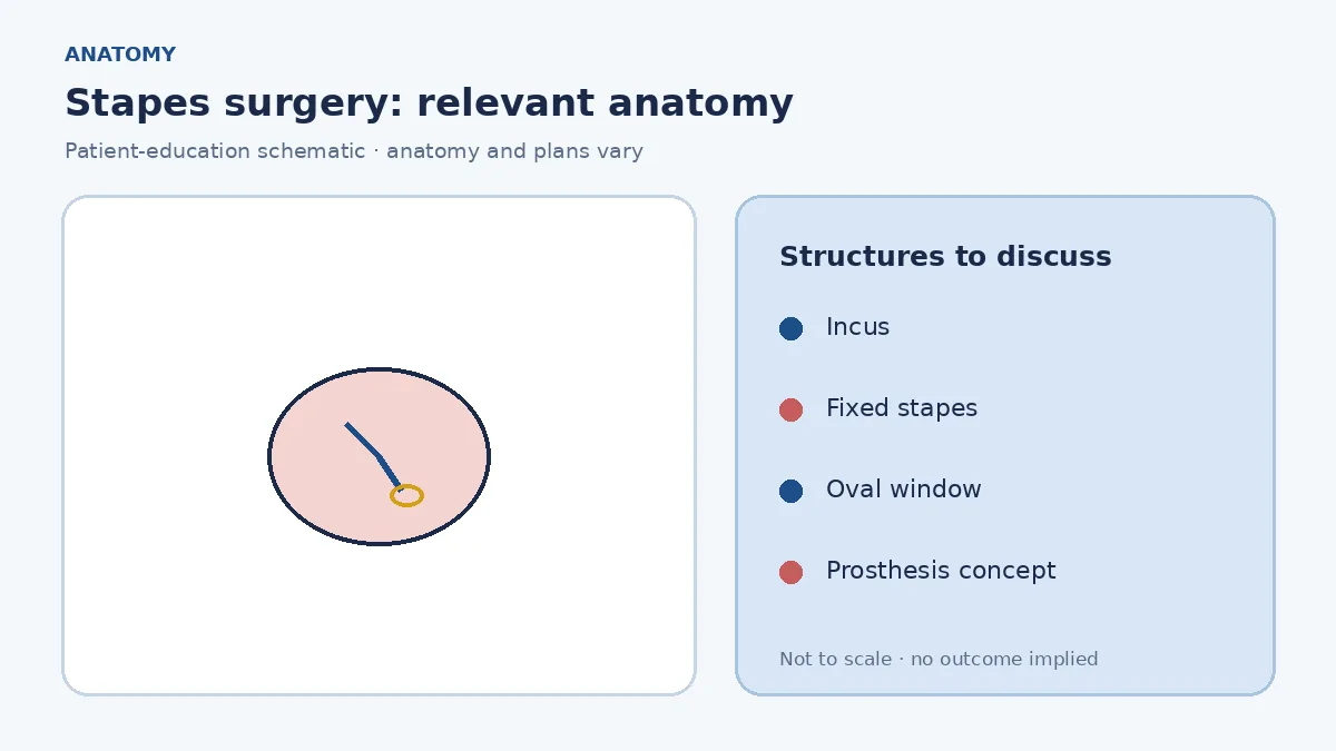 Medical illustration of the stapes bone in the oval window and fixation typical of otosclerosis