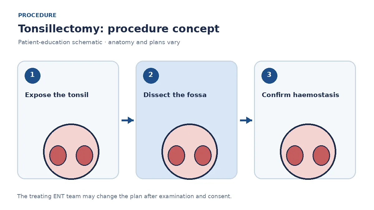 Clinical diagram of tonsil dissection from the tonsillar fossa during tonsillectomy