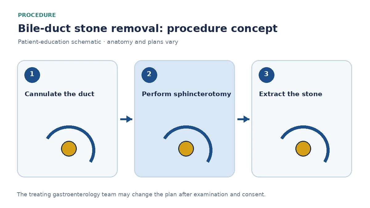 Clinical diagram of balloon extraction of a bile-duct stone after sphincterotomy