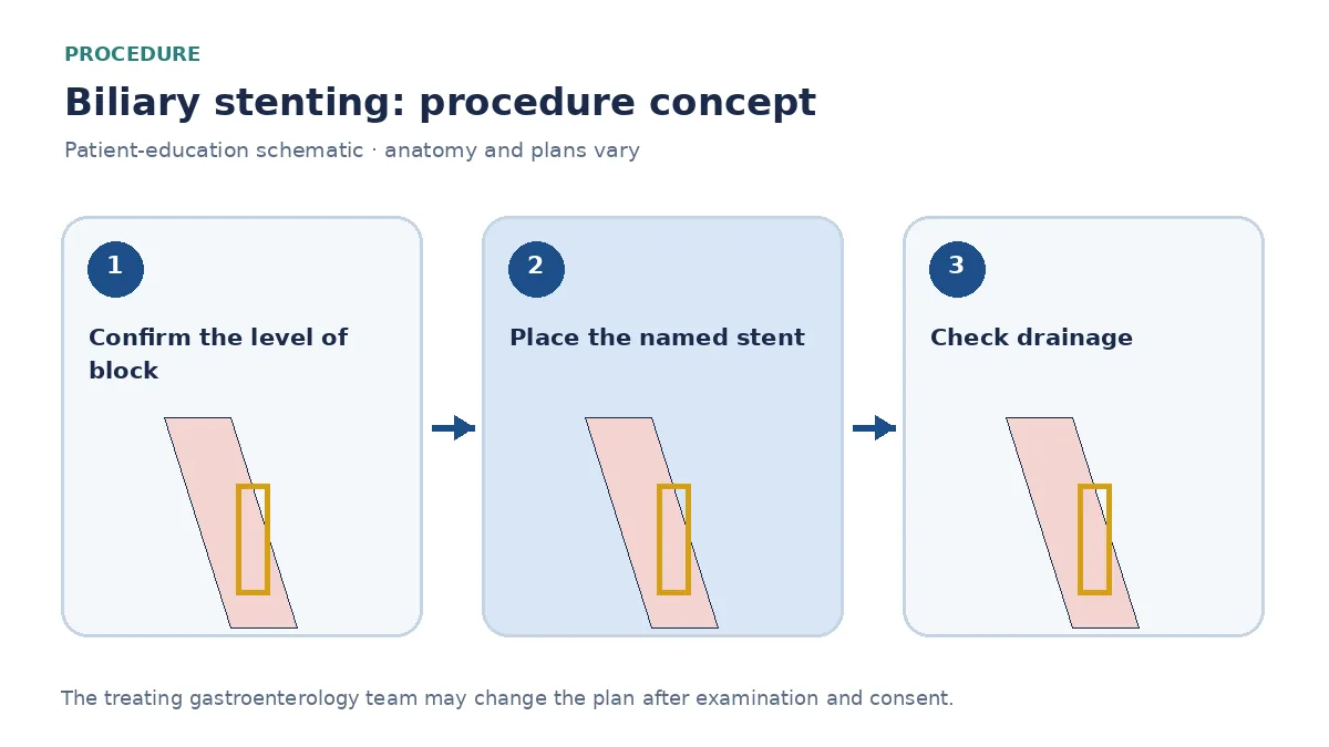 Clinical diagram of a plastic or metal stent crossing a biliary stricture