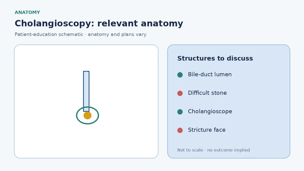 Medical illustration of a cholangioscope inside the bile duct looking at a stone or stricture