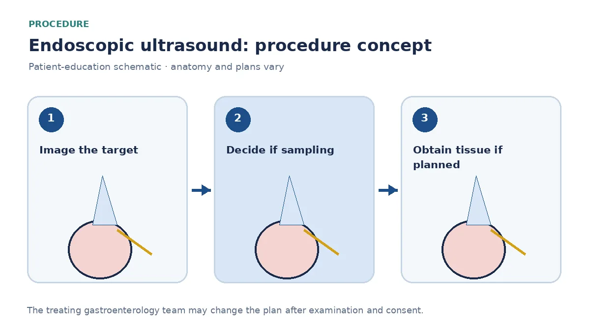 Clinical diagram of an echoendoscope and needle sampling a pancreatic lesion