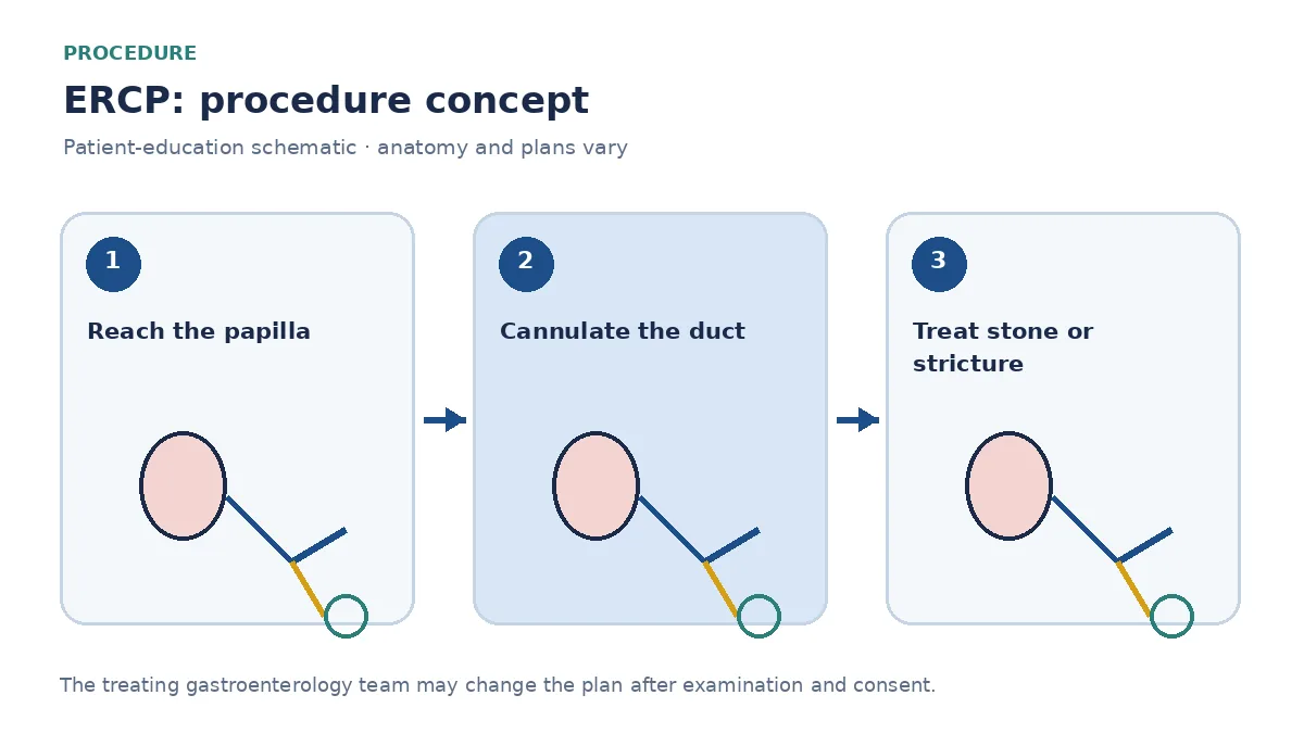 Clinical diagram of a side-viewing endoscope cannulating the bile duct during ERCP