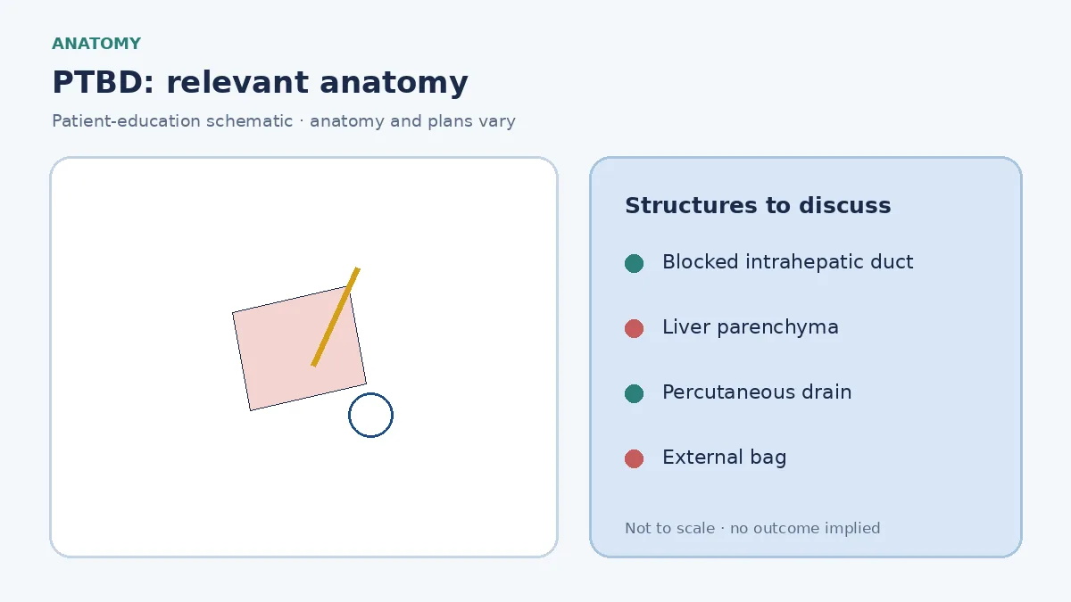 Medical illustration of a blocked bile duct inside the liver requiring percutaneous drainage