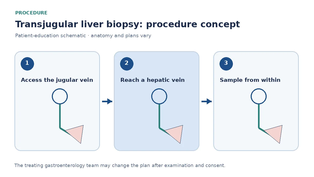 Clinical diagram of a transjugular needle sampling liver tissue from inside a hepatic vein