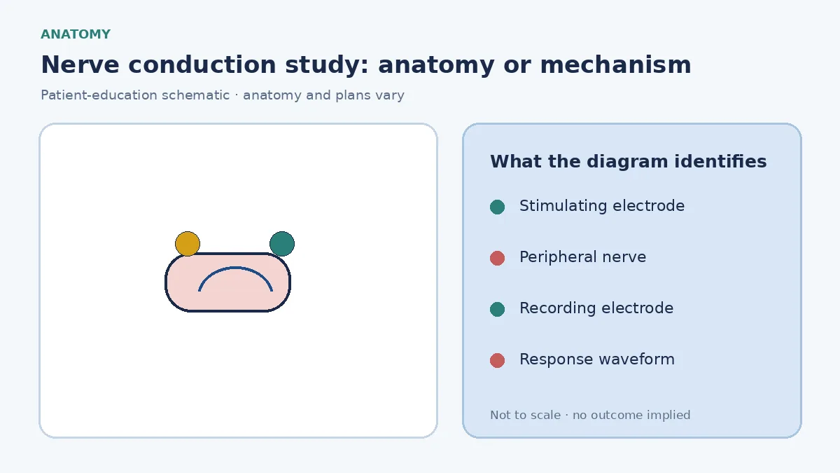Patient-education diagram showing surface stimulation and recording electrodes measuring motor and sensory nerve responses