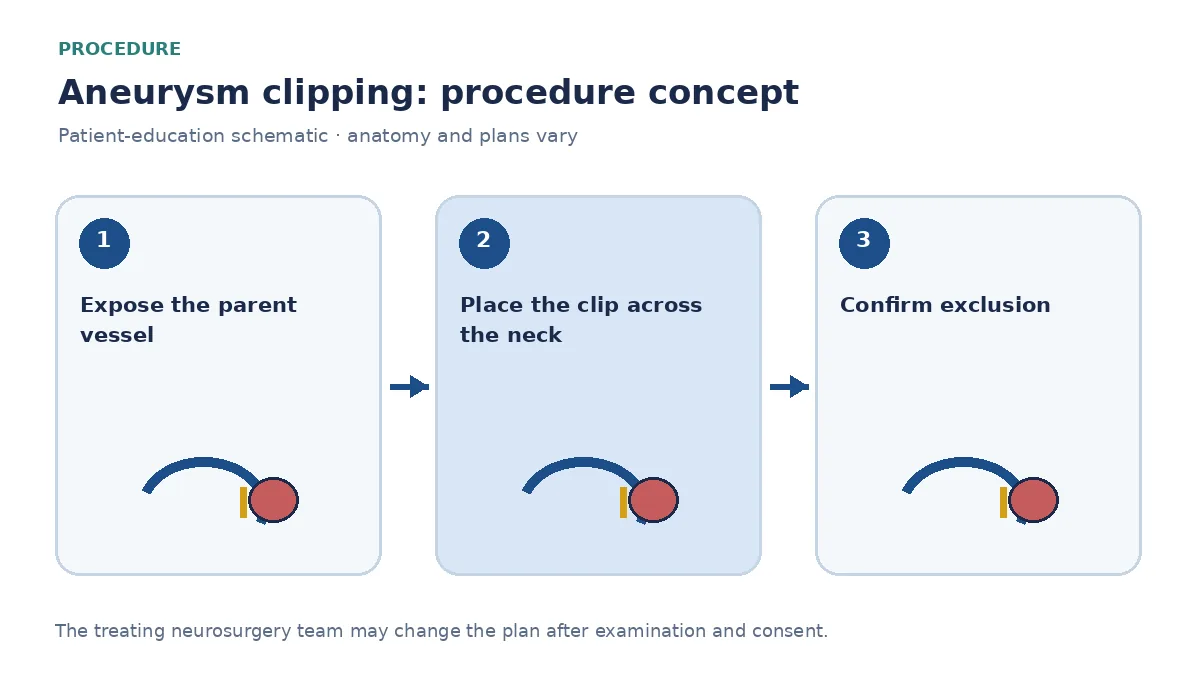 Clinical diagram of microsurgical clip placement across an aneurysm neck after craniotomy