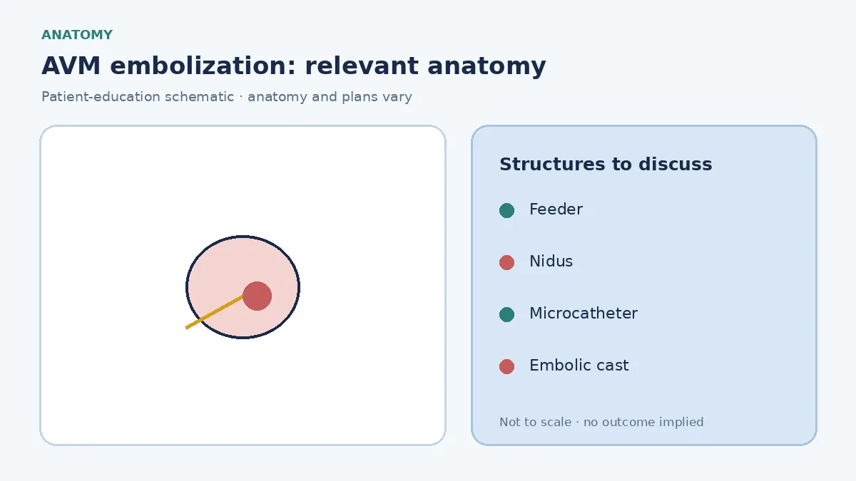 Medical illustration of an AVM nidus with a microcatheter in a feeding artery ready for embolization