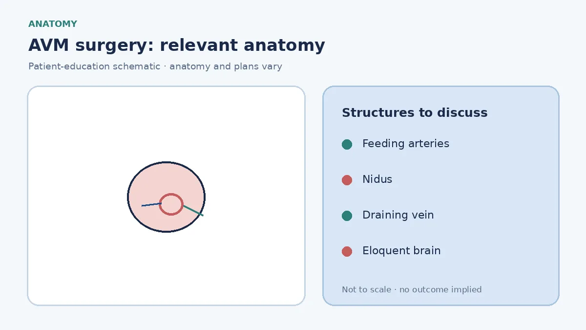 Medical illustration of a cerebral AVM nidus with feeding arteries and draining veins