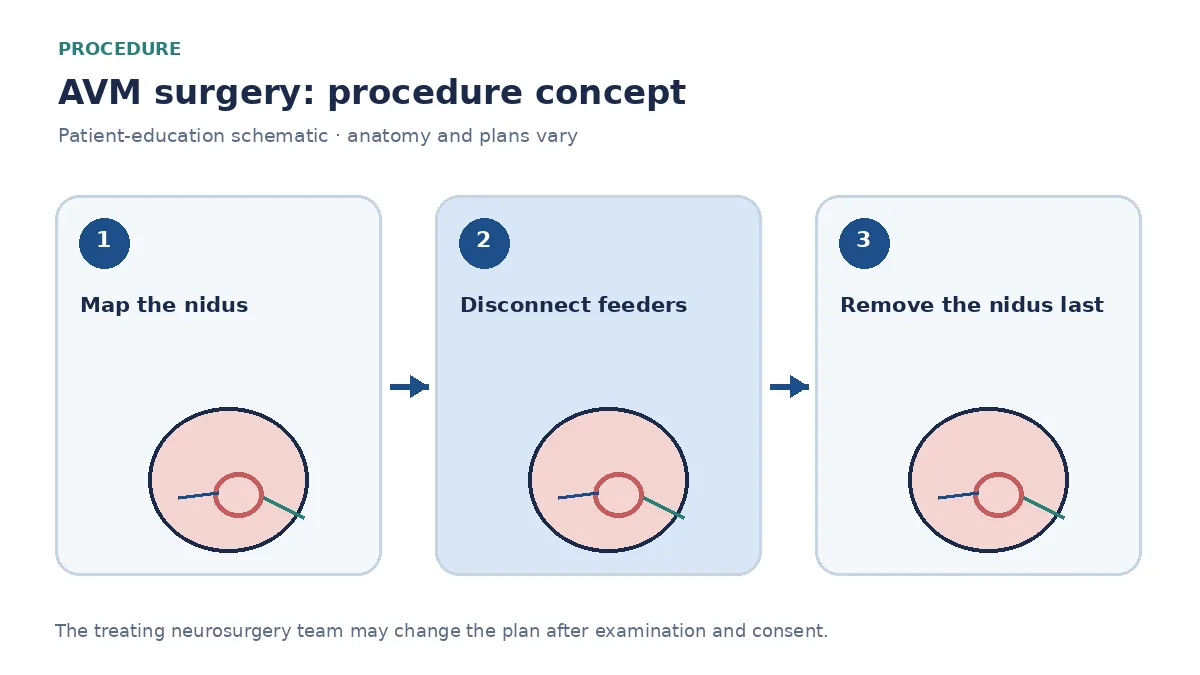 Clinical diagram of microsurgical AVM resection after craniotomy, taking feeders before the draining vein