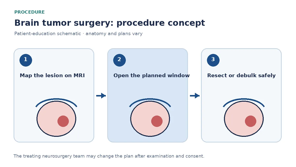 Clinical diagram of craniotomy, tumour resection and neuronavigation used in brain tumor surgery