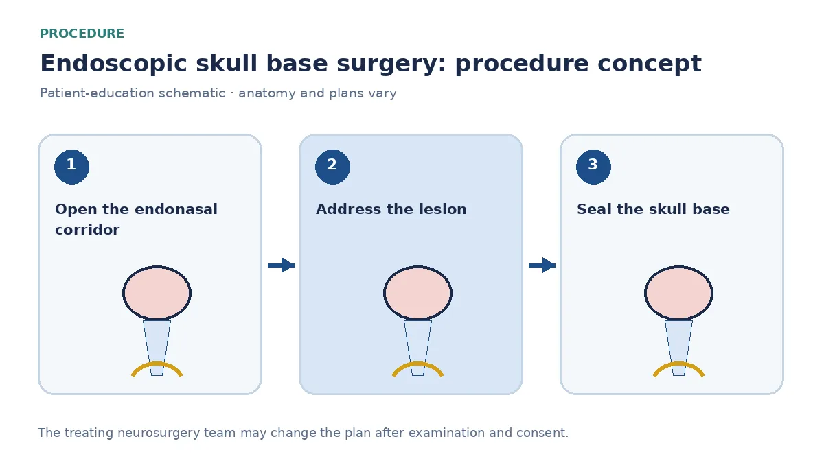 Clinical diagram of endoscopic skull-base resection and nasoseptal-flap reconstruction