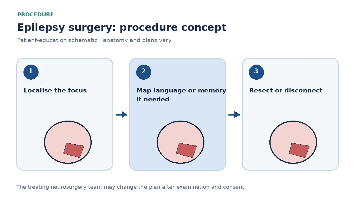 Clinical diagram of temporal-lobe resection or disconnection used for drug-resistant epilepsy