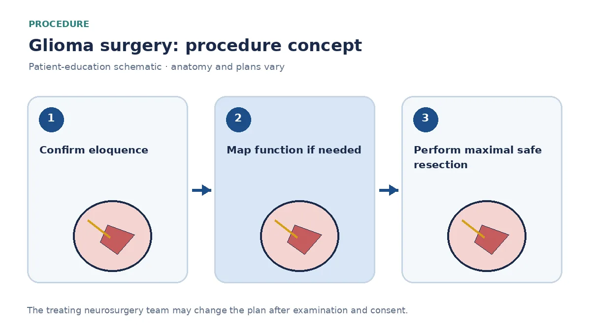 Clinical diagram of glioma resection using neuronavigation and optional awake mapping