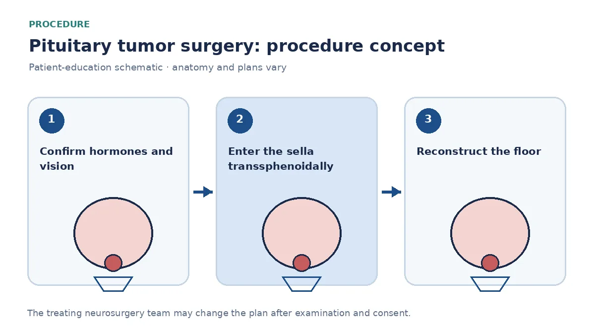 Clinical diagram of transsphenoidal endoscopic removal of a pituitary tumour and sellar reconstruction