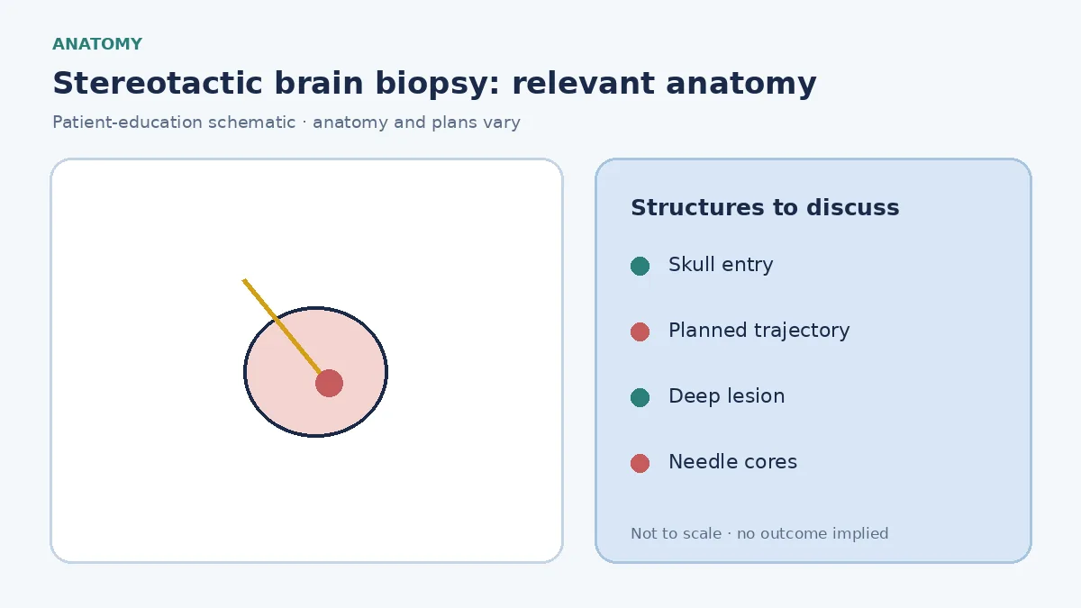 Medical illustration of a stereotactic trajectory from the skull surface to a deep brain lesion