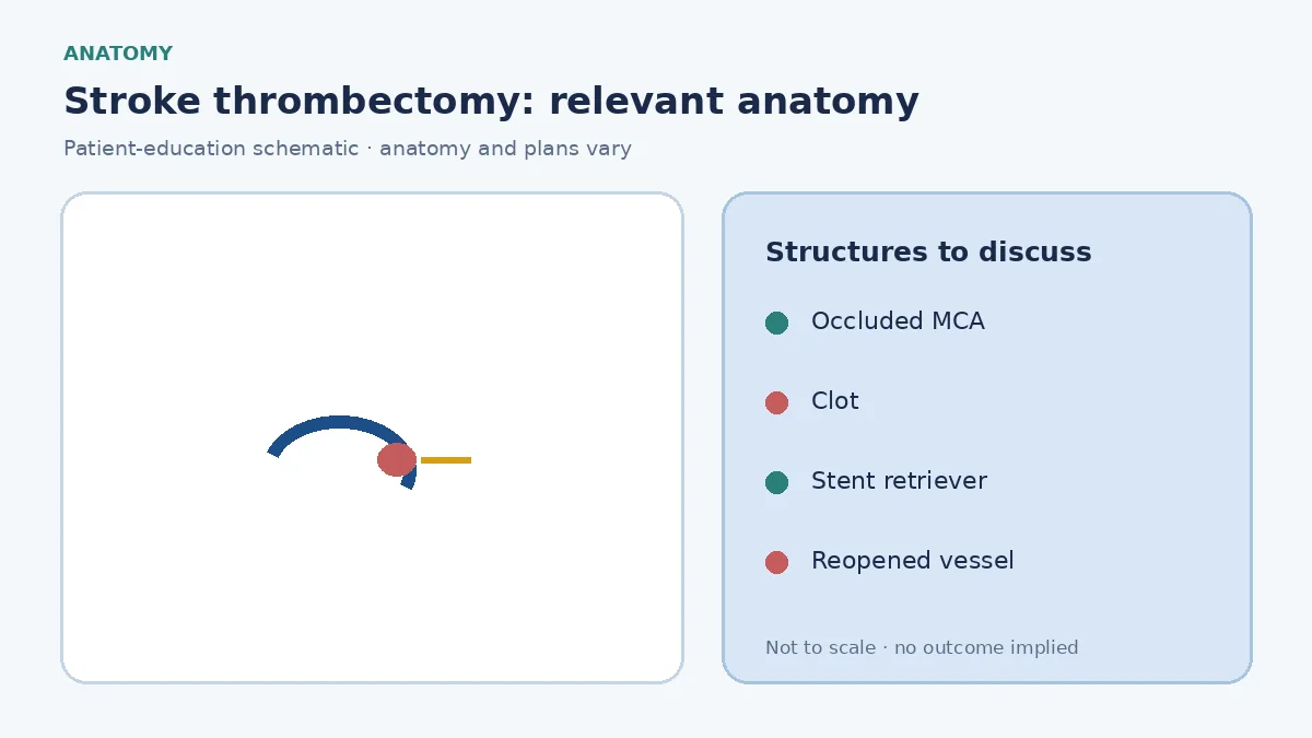 Medical illustration of a large-vessel occlusion in the middle cerebral artery causing acute ischaemic stroke