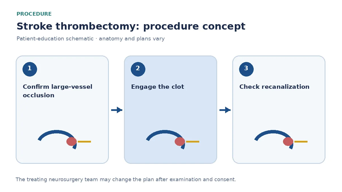 Clinical diagram of endovascular stent-retriever thrombectomy removing intracranial clot