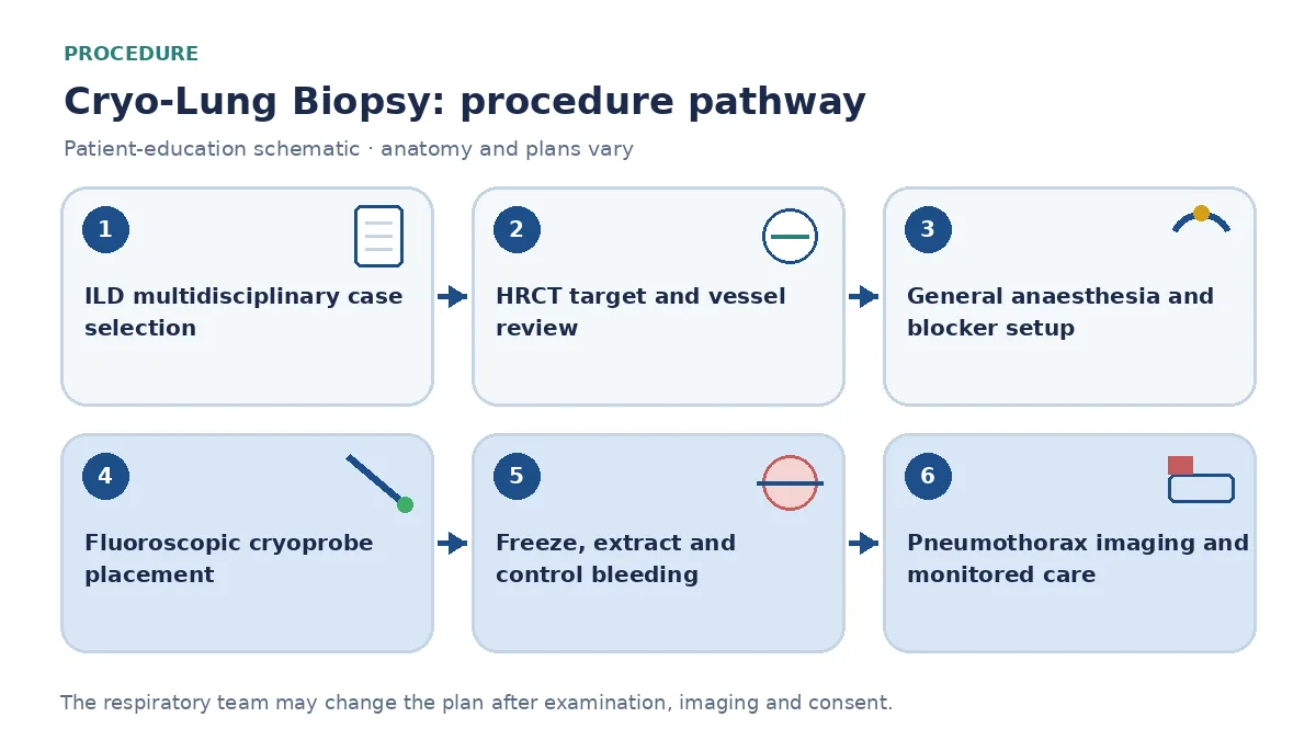 Cryo-lung-biopsy pathway showing ILD multidisciplinary selection, HRCT vessel and target review, general anaesthesia with blocker, fluoroscopic probe placement, freeze extraction, haemostasis and pneumothorax imaging