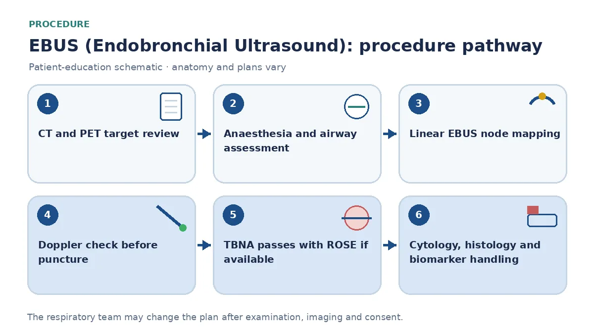 Six-step EBUS pathway showing CT and PET node mapping, anaesthesia assessment, ultrasound station identification, Doppler safety check, TBNA passes with optional ROSE and planned laboratory allocation