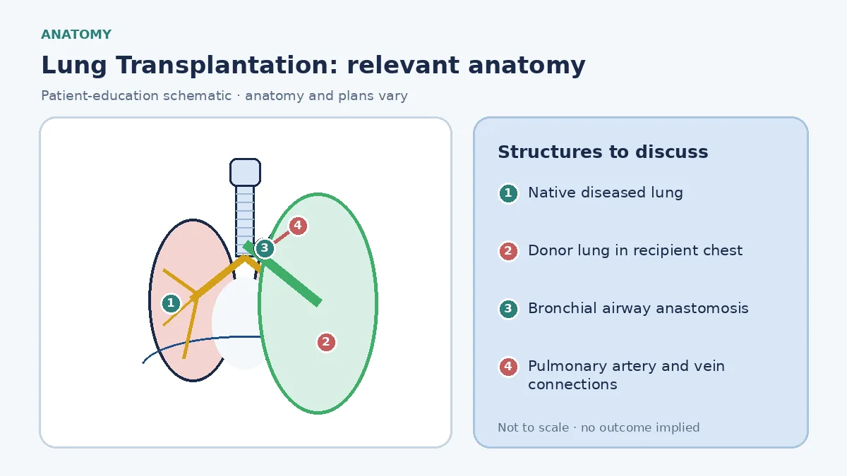 Educational transplant schematic comparing a diseased native lung with a donor lung in the recipient chest and labelling bronchial, pulmonary-artery and atrial-cuff anastomoses without implying outcome