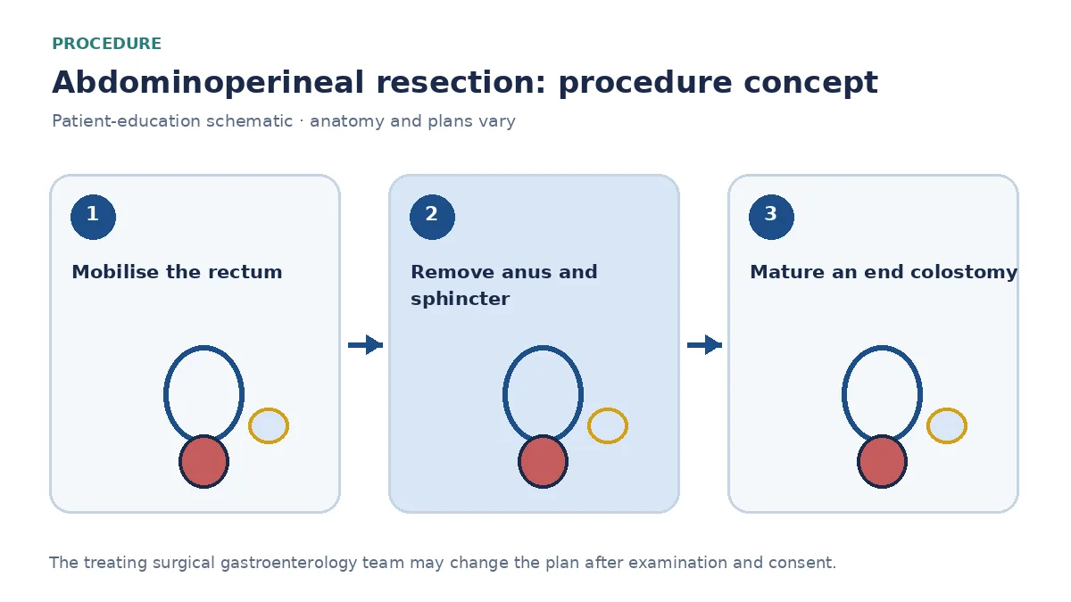 Clinical diagram of abdominoperineal resection with permanent end colostomy and perineal wound