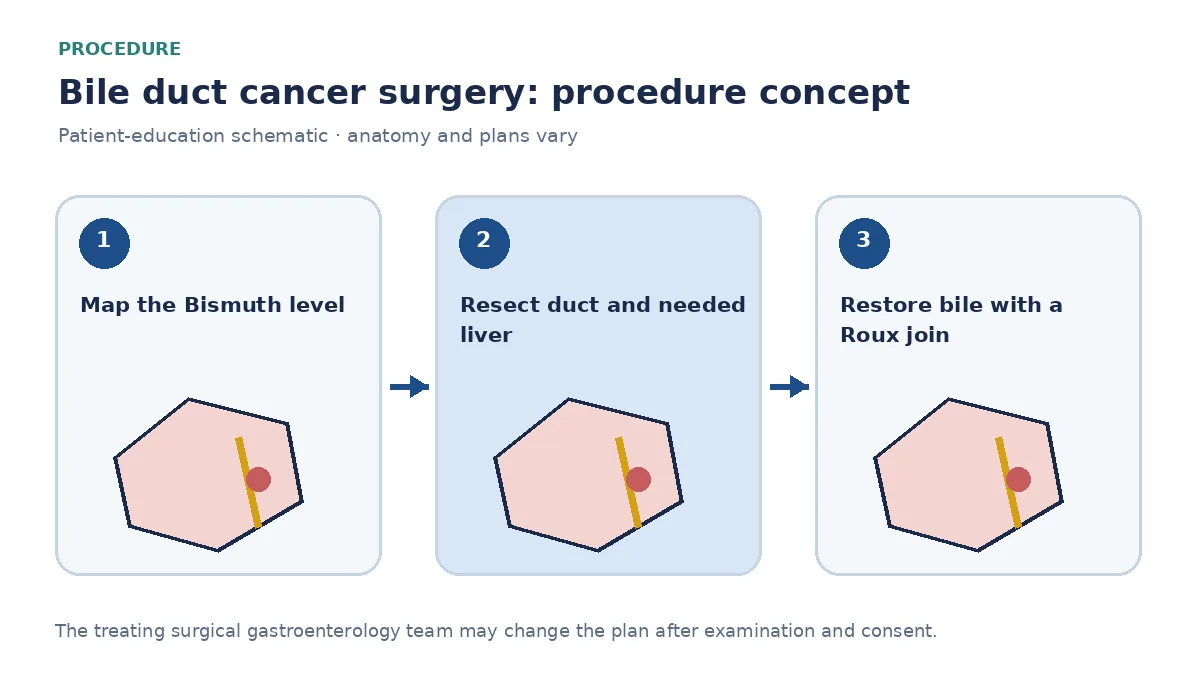 Clinical diagram of bile-duct resection with hepaticojejunostomy and optional hemihepatectomy