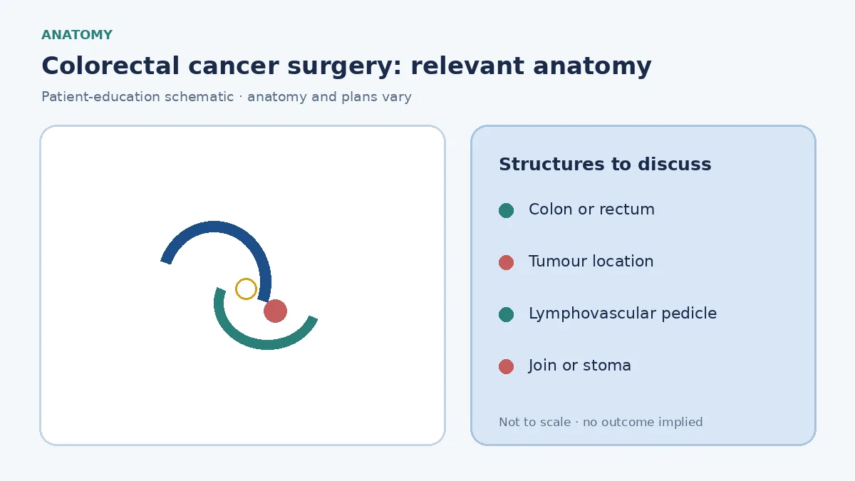 Medical illustration of the colon and rectum showing a tumour location that may require colorectal cancer surgery