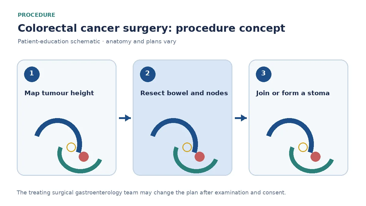 Clinical diagram of bowel resection, lymphovascular pedicle and anastomosis or stoma reconstruction