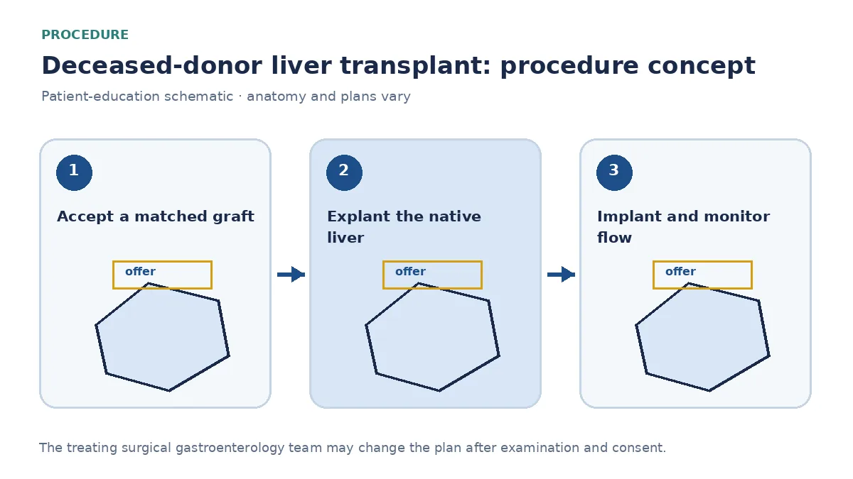 Clinical diagram of deceased-donor liver implantation after native hepatectomy