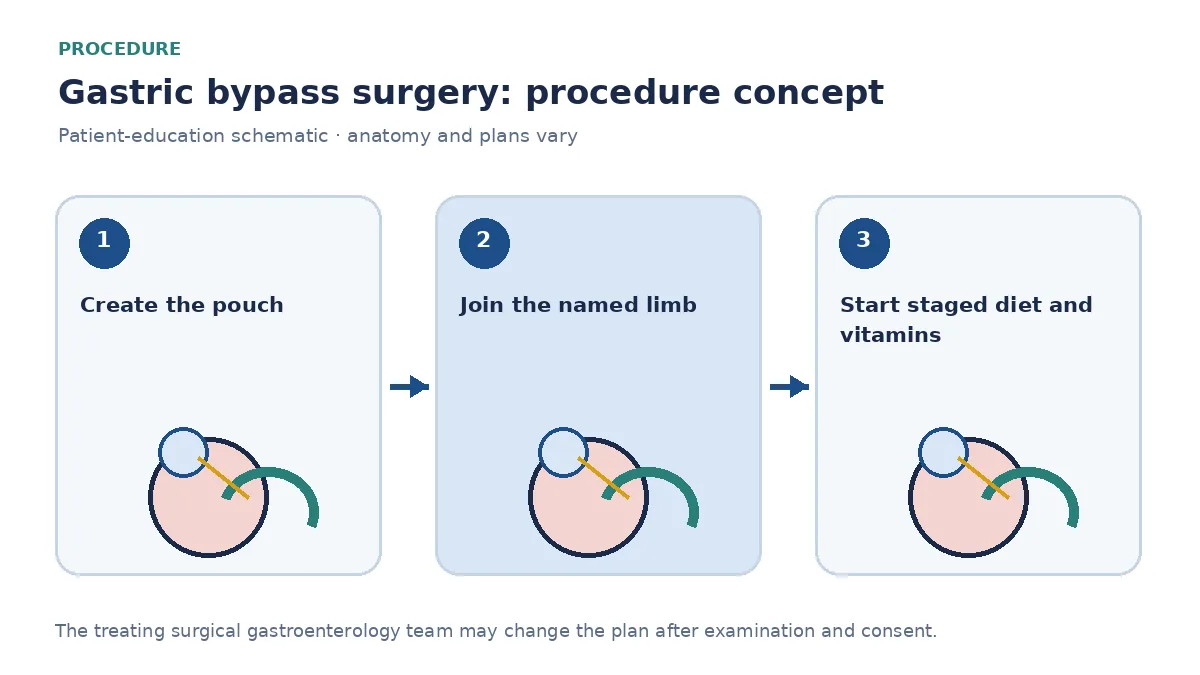 Clinical diagram of gastric-pouch creation and gastrojejunal anastomosis used in gastric bypass surgery