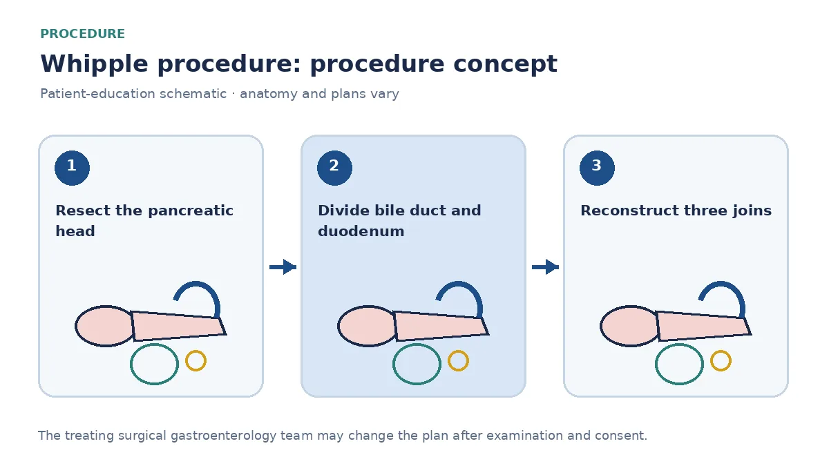 Clinical diagram of pancreaticoduodenectomy and reconstruction with pancreatic, biliary and intestinal anastomoses