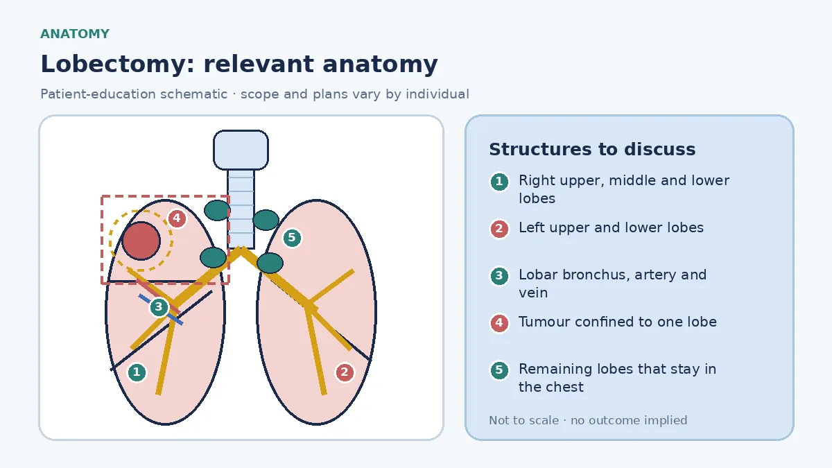 Medical illustration of lobectomy anatomy: the five pulmonary lobes, a tumour confined to one lobe, the lobar bronchus artery and vein divided at their origin, and the remaining lobes that stay in the chest.