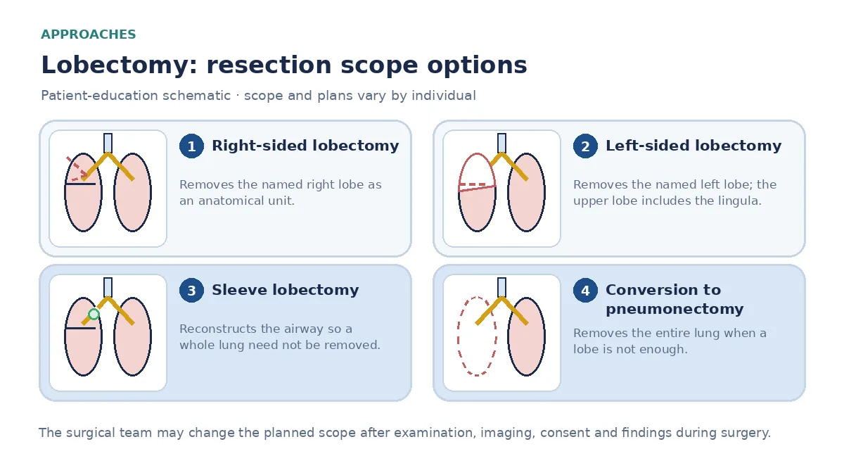 Medical infographic comparing right upper lobectomy, left lower lobectomy, sleeve lobectomy reconstructing the airway, and conversion to pneumonectomy when a lobe is not enough.