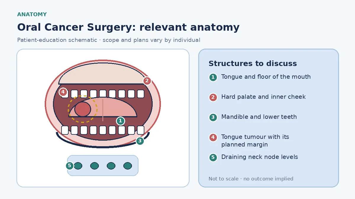 Medical illustration of oral cavity anatomy for cancer surgery: tongue, floor of mouth, inner cheek, hard palate and mandible, with a tongue tumour, the planned resection margin around it, and the draining neck node levels.
