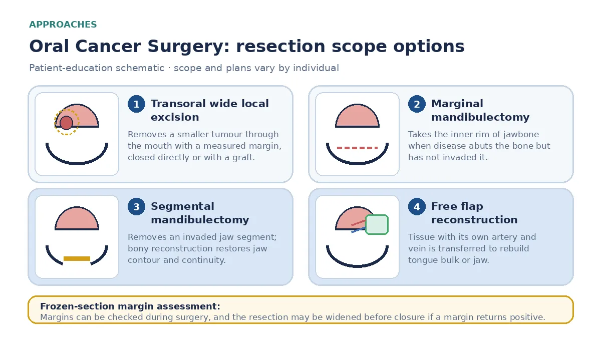 Medical infographic comparing transoral wide local excision, marginal mandibulectomy, segmental mandibulectomy with bony reconstruction and free flap reconstruction, alongside frozen-section margin assessment.