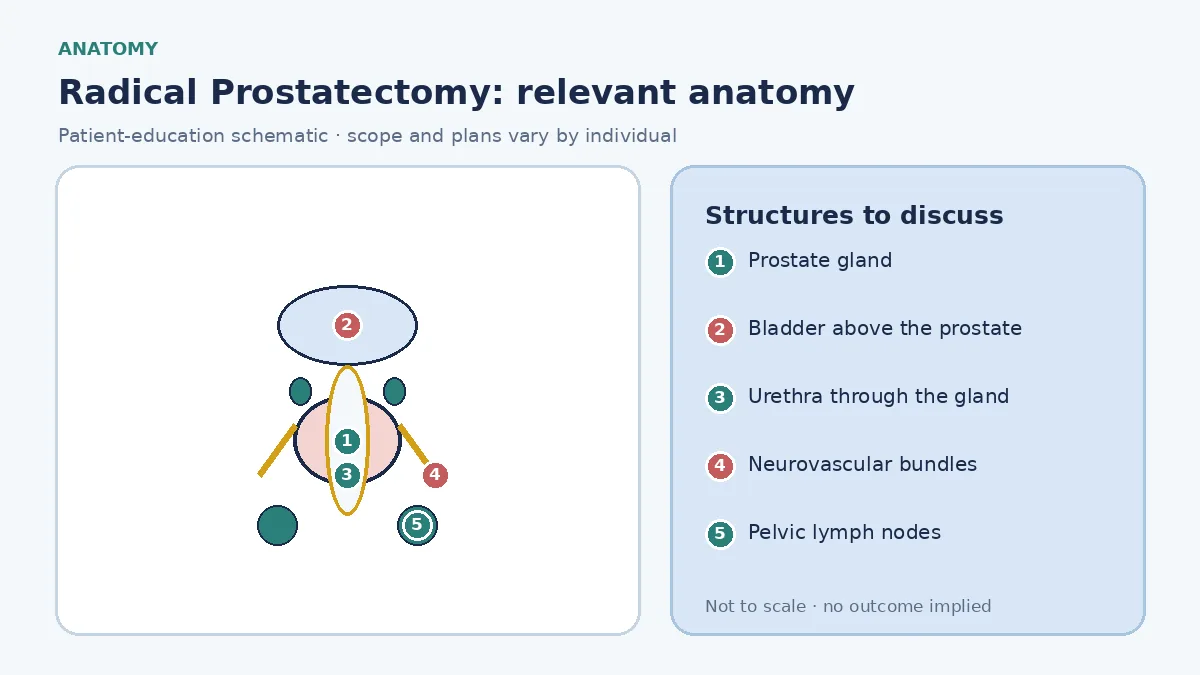 Medical illustration of prostate anatomy for cancer surgery: prostate below the bladder, seminal vesicles, urethra, the neurovascular bundles along each side, and the pelvic nodes sometimes removed for staging.