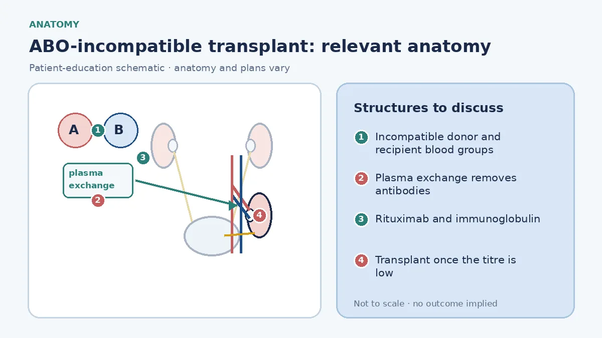 Medical infographic of ABO-incompatible transplantation showing incompatible donor and recipient blood groups, plasma exchange removing anti-blood-group antibodies from the recipient and the donor kidney implanted after the titre falls