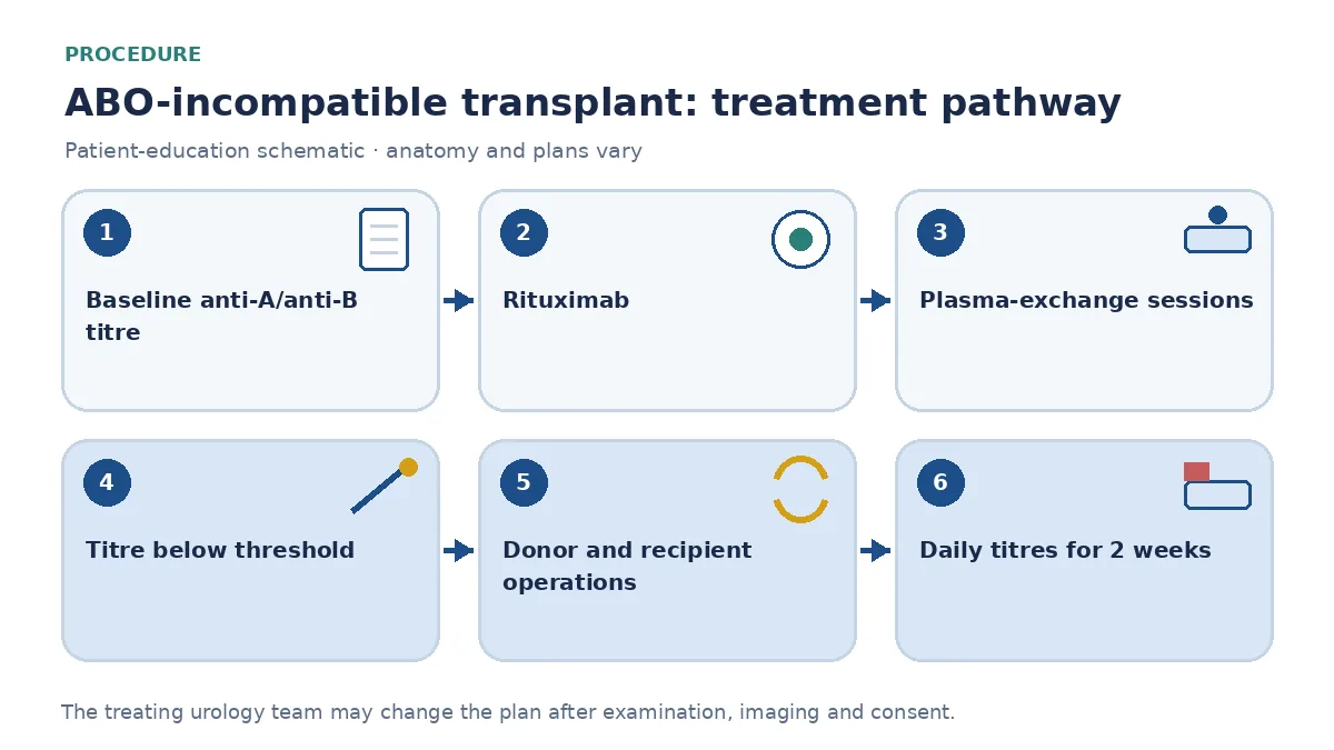 Step-by-step ABO-incompatible transplantation pathway infographic showing baseline titre and crossmatch, rituximab and plasma-exchange sessions, titre threshold check, donor and recipient operations and daily titre monitoring