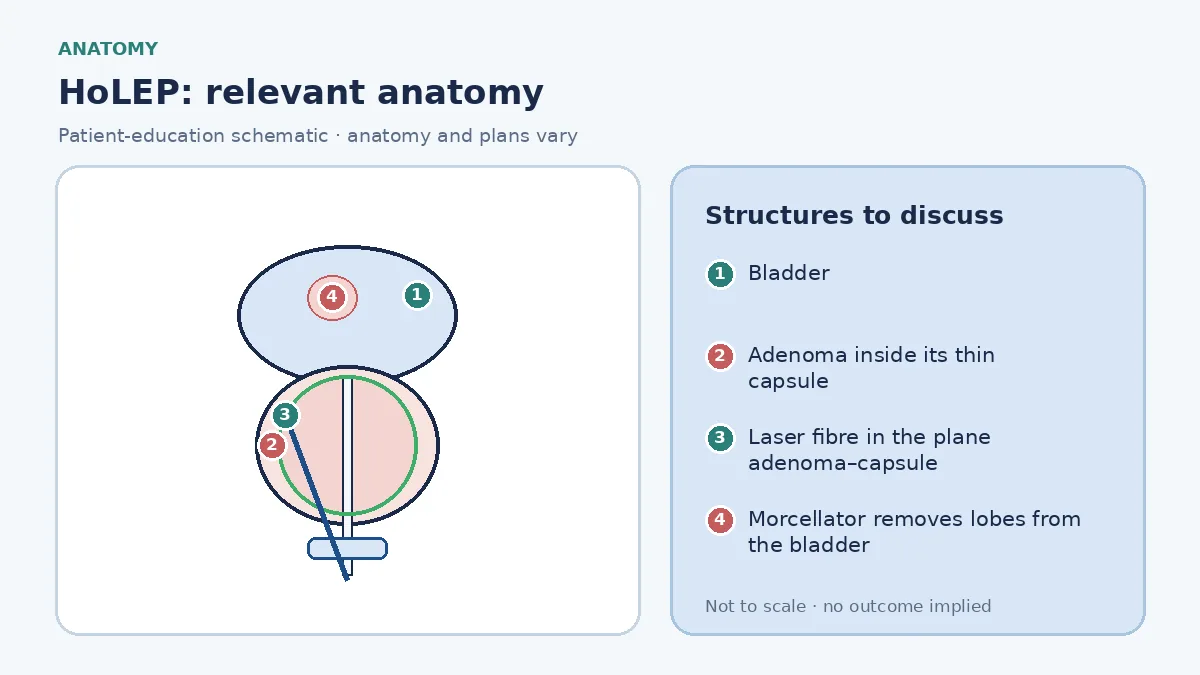 Medical infographic of HoLEP anatomy showing the bladder, an enlarged prostate adenoma inside its thin capsule compressing the urethra, and a laser fibre developing the plane between adenoma and capsule