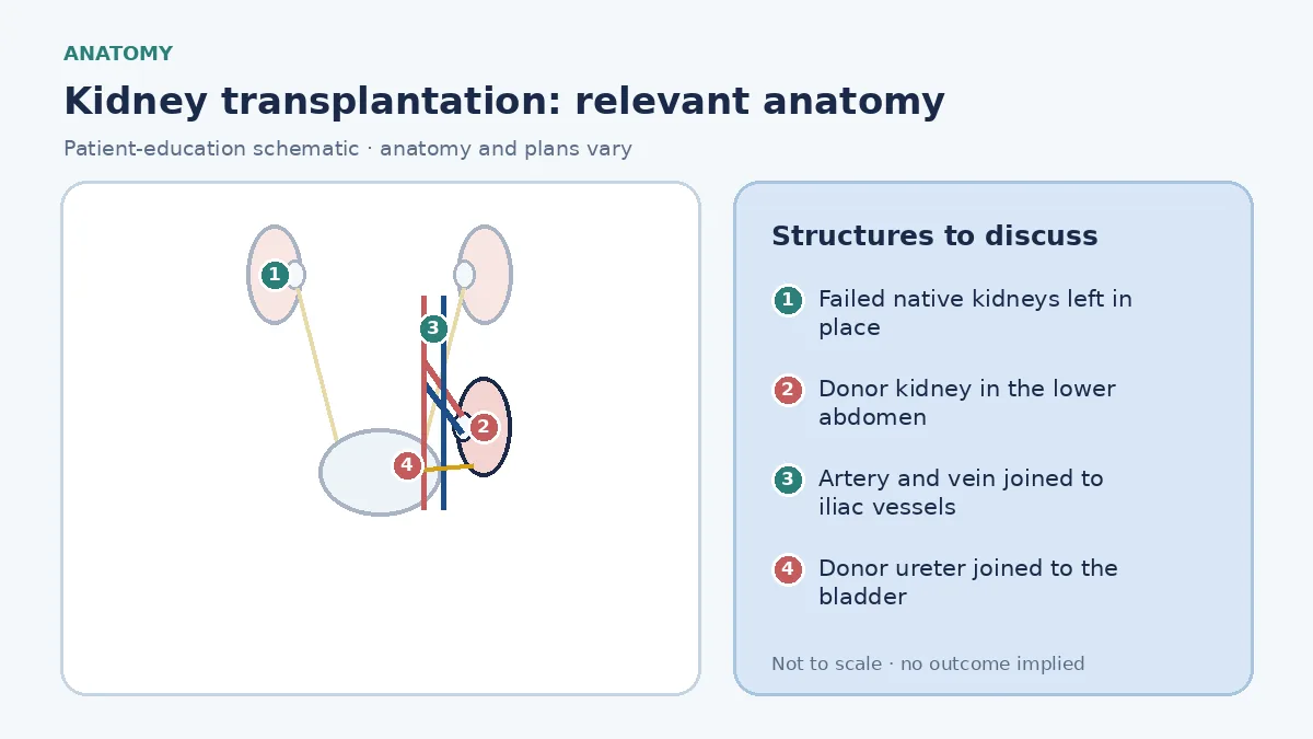 Medical infographic of kidney transplantation anatomy showing the failed native kidneys left in place and a donor kidney in the lower abdomen with its artery and vein joined to the iliac vessels and its ureter joined to the bladder