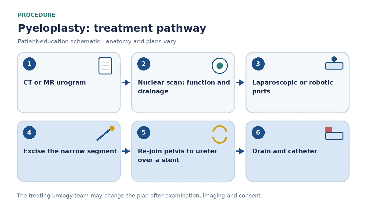 Step-by-step pyeloplasty pathway infographic showing CT or MR urogram, nuclear renal scan, laparoscopic or robotic port placement, excision of the narrowed segment, re-joining pelvis to ureter over a stent and drain placement